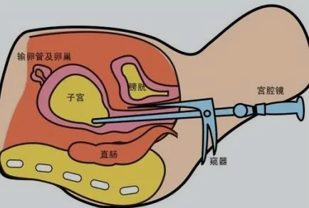 amh0.23做试管婴儿有没有希望