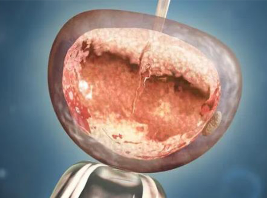 c型内膜转化后多久能移植囊胚