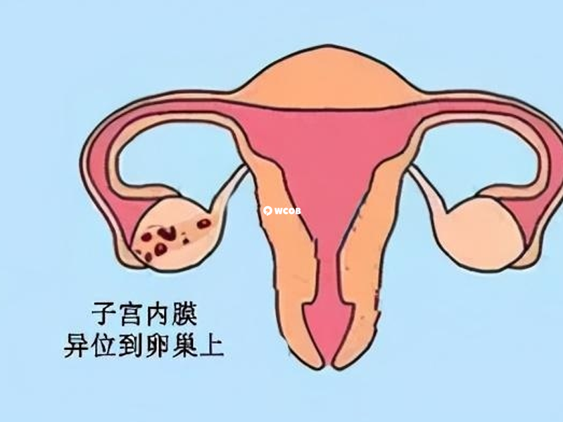 子宫内膜异位症打达菲林会出现肠胃不适