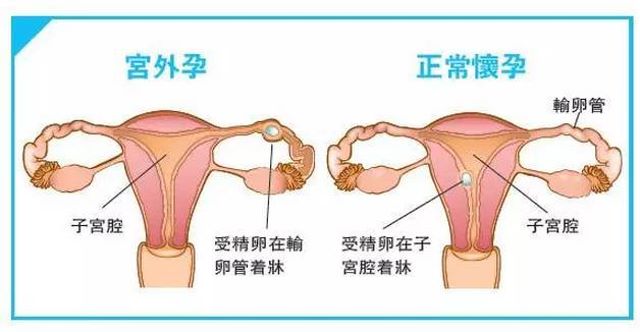 宫外孕的症状有哪些