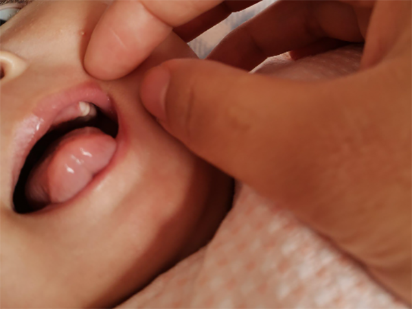 婴儿鹅口疮最早期症状图片分享