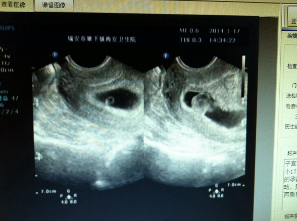 妊娠囊大小与孕周对照表分享