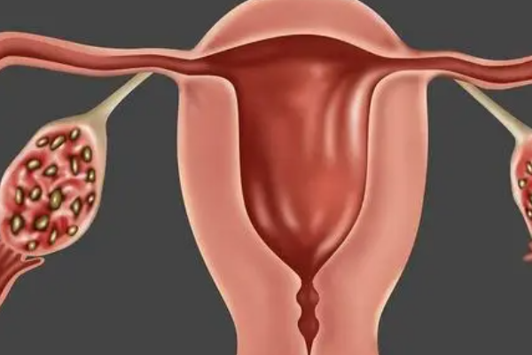 详解多囊卵巢做试管是优势还是劣势