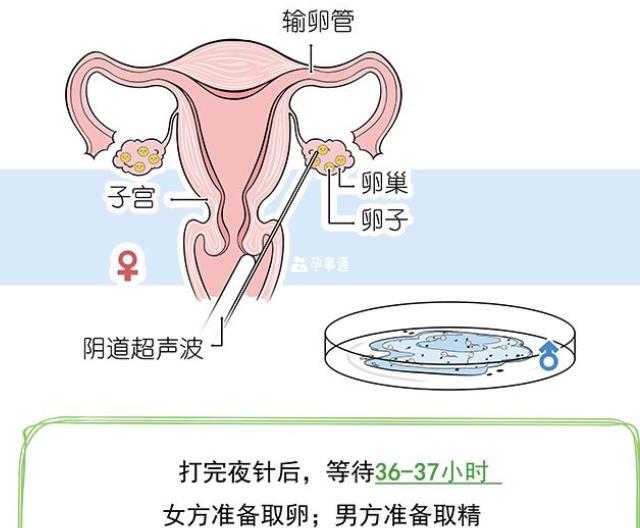 試管女方取卵男方取精