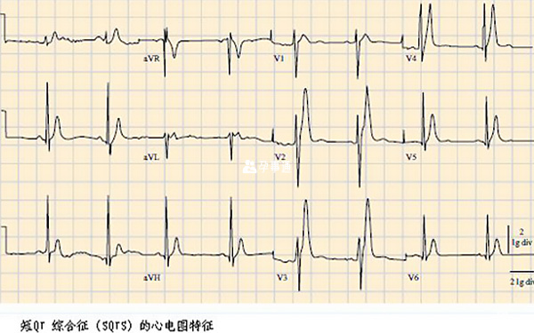 短QT综合征的心电图特征