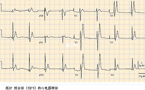 短QT綜合徵的心電圖特徵
