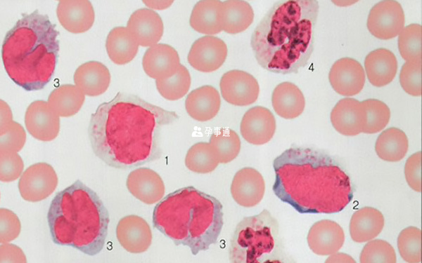慢性粒细胞白血病