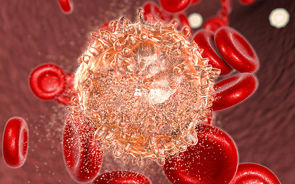 PDGFRB相关的慢性嗜酸性粒细胞白血病