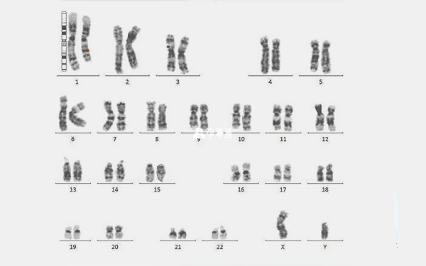 染色體檢查結果怎麼看