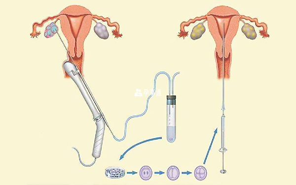 试管婴儿取卵手术过程