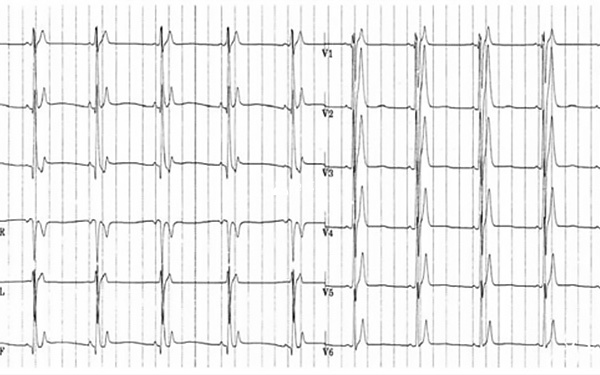 短QT间期综合征患者心电图