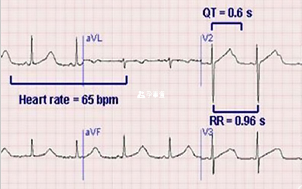 QT间期延长综合症心电图