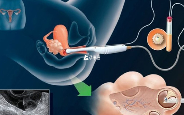 卵泡穿刺的过程
