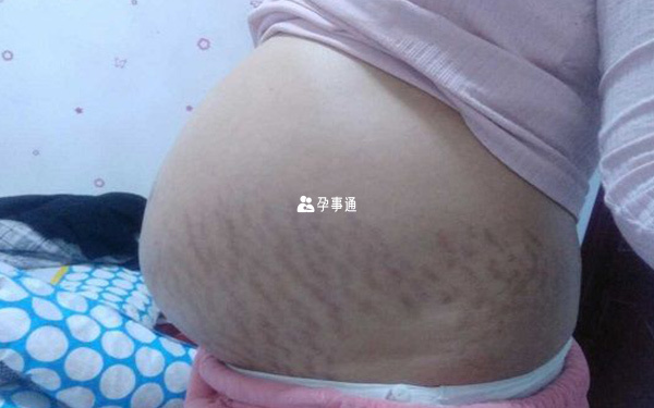 妊娠纹在产后将会发生变化