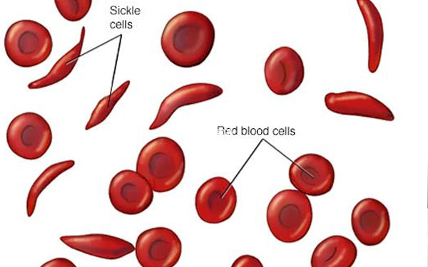 镰刀型细胞贫血病