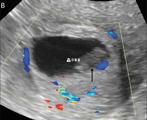 B超下卵黄囊消失