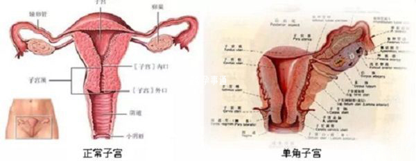 什么是单角子宫