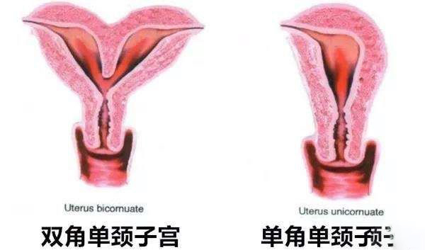 單角子宮和雙角子宮的區別