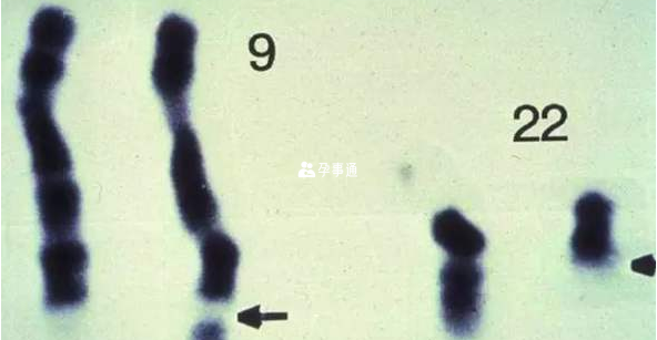 9號與22號染色體發生了易位