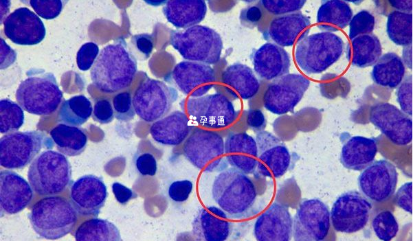 急性早幼粒细胞白血病