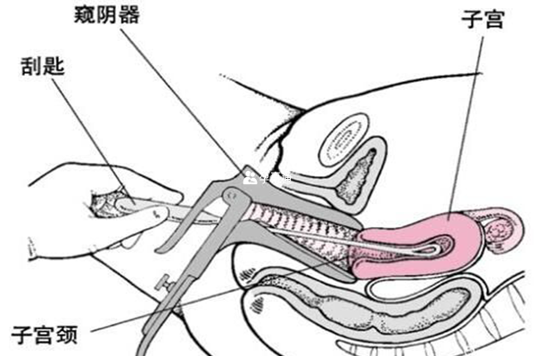 刮宫术（示意图）