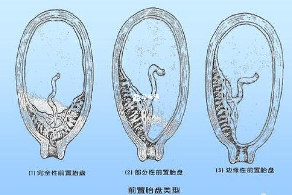 前置胎盘示意图