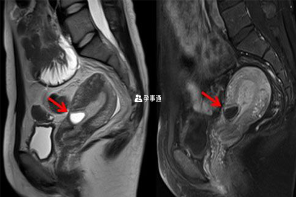 子宫肌层局限性变薄提示为子宫瘢痕处，并见瘢痕处孕囊附着(红色箭头所示)