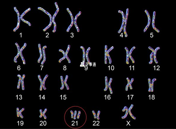 染色体异常会遗传疾病