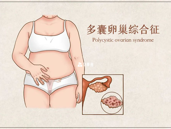 腹水多发于多囊卵巢患者
