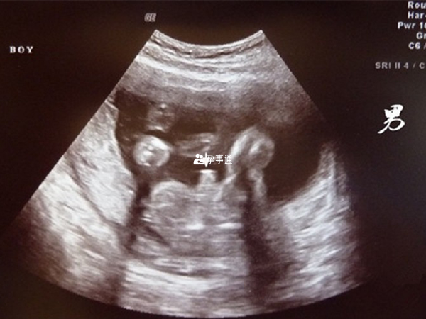 b超两点判断男孩的方法主要是观察胎儿的生殖器官