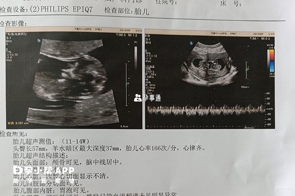 胎儿头型突出怀女孩可能性大