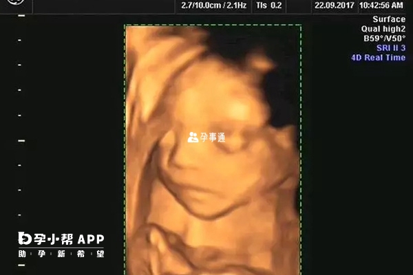 通过四维图像预测胎儿性别不一定准确