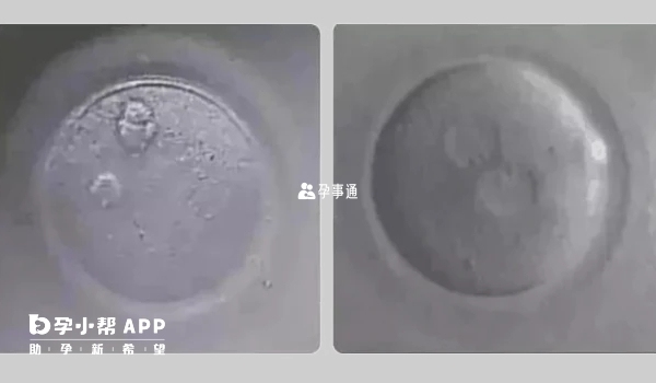 最适合移植的是2pn胚胎