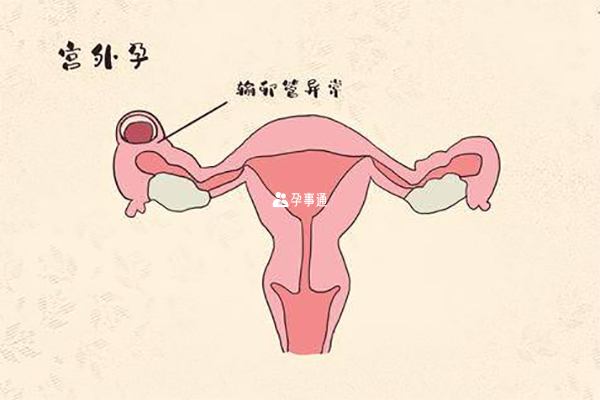 宫外孕早期7个征兆介绍