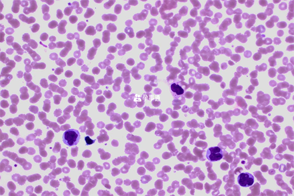 急性髓系白细胞