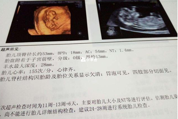 nt是孕期所做的第一个排畸检查