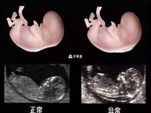 nt检查通过胎儿颈后透明带厚度判断胎儿是否异常