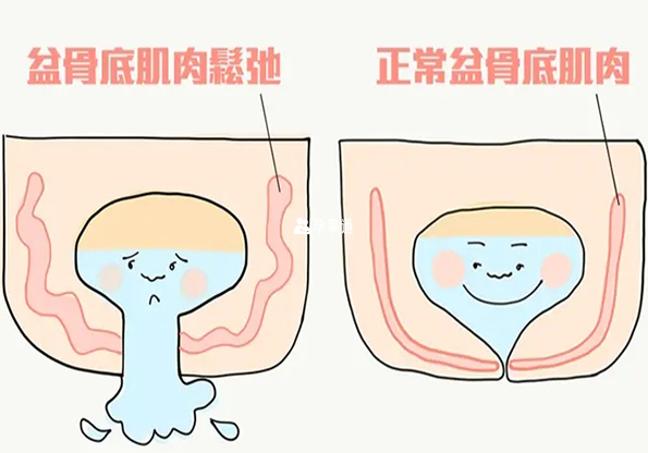 盆底肌修复需在专业医院操作