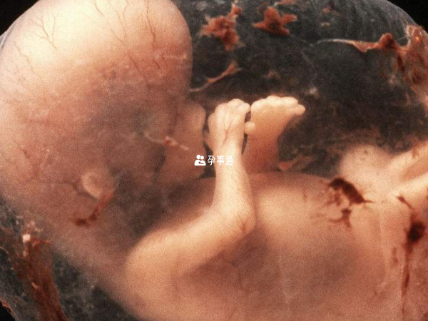 维生素A的缺乏可能会导致胎儿畸形
