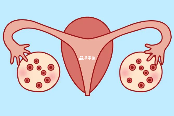 多囊卵巢影响妊娠结局