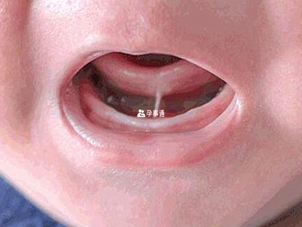 婴儿舌系带断应该怎么办解析