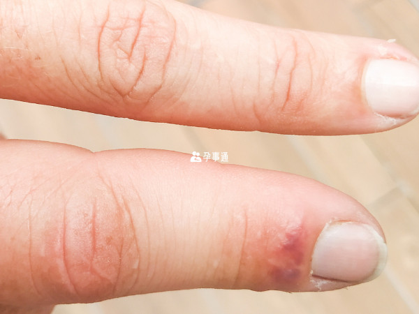 手指肿胀需要警惕的四种疾病一览