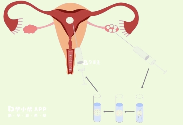 取卵9天后小腹痛可能是感染