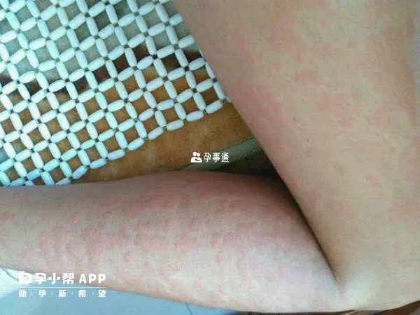 荨麻疹是一种皮肤病