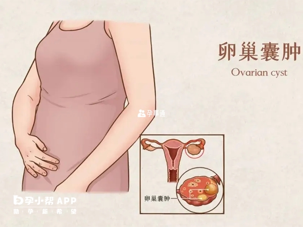 卵巢囊肿分两种情况