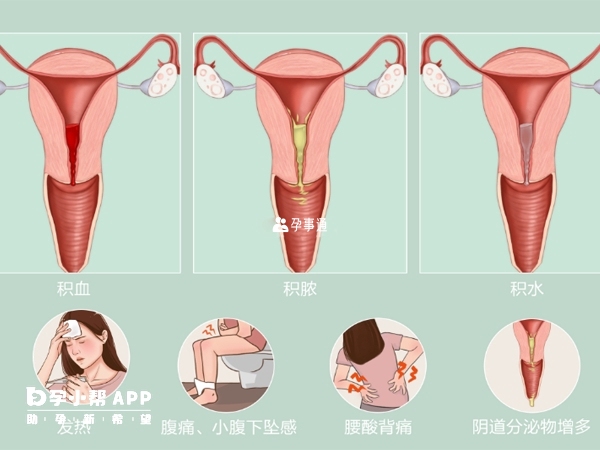 宮腔積液分生理和病理性