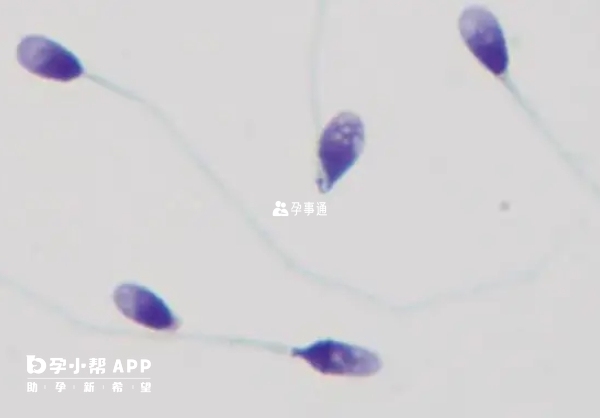 圓頭精子應該做二代試管助孕