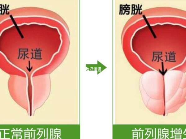 前列腺增生可能会影响生育能力