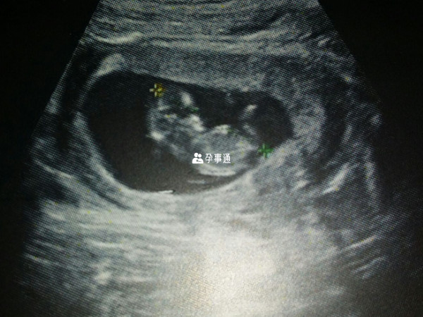 nub点是指宝宝在12周左右开始发育的生殖器