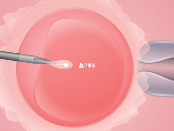 供卵试管婴儿是人类辅助生殖技术之一